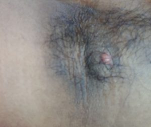 Hidradenitis-ayurveda-treatment